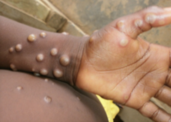 Akwa Ibom Records Eight Cases of Mpox, Launches Awareness Campaign