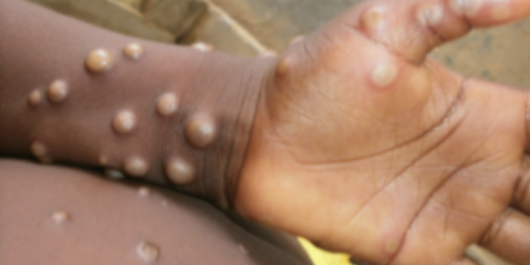 Akwa Ibom Records Eight Cases of Mpox, Launches Awareness Campaign