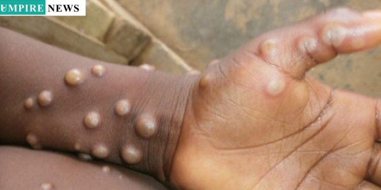 Cross River State Mobilize 200 Volunteers to Combat Mpox Outbreak